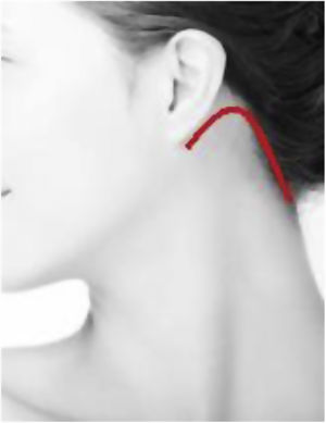 Retroauricular approach.