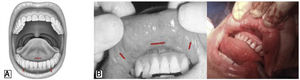 (A) Transoral sublingual and vestibular approach with insufflation of CO2; (B) vestibular transoral approach with insufflation of CO2 (TOETVA).