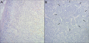 Microscopic findings of the resected mass, with hematoxylin and eosin staining (magnification ×100): (A) Normal adrenal gland tissue. (B) Normal spleen tissue: small lymphocytes are observed in a concentric arrangement around arterioles (black arrows).