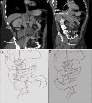 A and B) Coronal computed tomography image of the cystic lesion infiltrating the duodenum and large vessels, C) Image of the situation of the tumor in relation to the papilla, D) Image of the digestive reconstruction after duodenal resection.