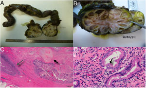 A) Duodenal invasion by a multicystic nodular mass, B) Image of the tumor with cysts of liquid content, and mucoid consistency in some, C) Presence of a fibrous infiltrating mass with areas that are mesenchymal in appearance with differentiation into cartilage (black arrow) and areas of inflammation and necrosis (grey arrow), D) Gland structures covered in epithelium, in some areas immature and in others showing differentiation into respiratory-like ciliated epithelium (black arrow), dissimilar from the mature intestinal epithelium covering the lumen.