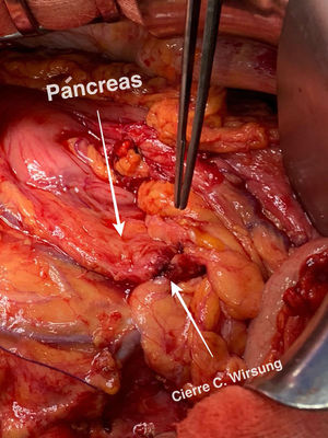 Primary closure of the Wirsung duct after pancreatic division.