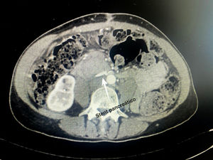 CT scan with visualization of the normal positioning of the proximal end of the pancreatic stent in the duodenum.