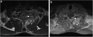 Magnetic resonance imaging (MRI): (a) weighted axial image in T2 at the level of the C6/C7 intervertebral space; (b) weighted in T1 at the C7 intervertebral space, revealing an inflammatory/infectious process with microabscesses (*) of the left paravertebral muscles (semispinalis capitis, spinalis cervicis and multifidus muscles) and occupation of the spinal canal by a left epidural abscess resulting in contralateral displacement of the spinal cord (⟵).