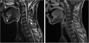 Magnetic resonance imaging (MRI): (a) weighted sagittal image in T2 of the cervical region demonstrating the presence of an epidural abscess at C6–C7–T1, occupying the spinal canal, and change in the spinal cord signal compatible with associated compressive myelopathy (⟵); (b) weighted sagittal image in T1 of the cervical region demonstrating the left posterolateral epidural collection (*) and obliteration of the subarachnoid space at this level.