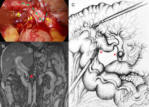 Cholecystocolic fistula between the gallbladder remnant and the hepatic flexure of the colon. (A) Intraoperative findings with arrows marking the common bile duct (A1), gallbladder remnant (A2) and fistula to the hepatic flexure of the colon (A3). (B) Preoperative MRI, gallstone in common bile duct (arrowhead). (C) Drawing of the cholecystocolic fistula and gallstone in the common bile duct (arrowheads).