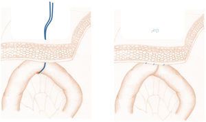 ‘Phantom’ jejunostomy marker with a vessel loop or attached to the parietal peritoneum, then marked on the skin.