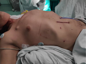 Exposure of the surgical wounds, vessel loop of the ‘phantom’ jejunostomy, without placement of drains or tubes.