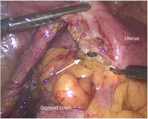 The colouterine fistula is observed (arrow); below, the sigmoid colon adhered towards the uterus, which is being dissected with electrocautery.