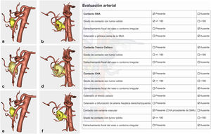 Arterial study extracted from the 3D model and information provided by the model. It provides a 360° view of the relationship of the tumor with the most important arterial structures (SMA, celiac trunk and its collateral branches, and anatomical variants).