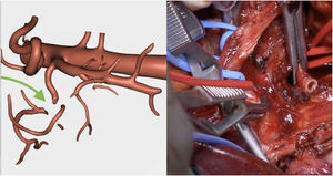 (a) Resection of the RHA estimated by the 3D model; (b) Surgical image with the resection of the RHA that had been predicted by the 3D model.
