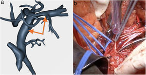 (a) Resection of the SMV estimated by the model; (b) Surgical image with the resection of the SMV that the 3D model had predicted.