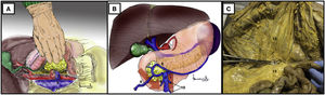 (A) Retroperitoneal approach after duodenal-pancreatic traction towards the patient’s left shoulder. (B) Identification of the gastrocolic trunk of Henle by means of a supramesocolic approach of the superior mesenteric artery. The red arrow indicates the direction of dissection to approach the superior mesenteric artery. (C) Simulation of the inframesocolic approach in formaldehyde-treated cadaver, superior traction of the transverse colon and inferior traction of the first jejunal loop. 1: superior mesenteric artery; 2: superior mesenteric vein; 3: left renal vein; 4: aorta; 5: vena cava; 6: right gastroepiploic vein; 7: anterosuperior pancreaticoduodenal vein; 8: right superior colic vein; 9: middle colic vein; 10: jejunal veins; 11: transverse colon; 12: mesocolon; 13: mesentery; 14: first jejunal loop. The color of the figure can only be seen in the electronic version.