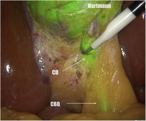 Dissection behind Calot’s triangle and lateral to the gallbladder. CD: cystic duct.