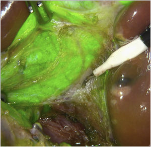 Dissection place of the liver parenchyma.