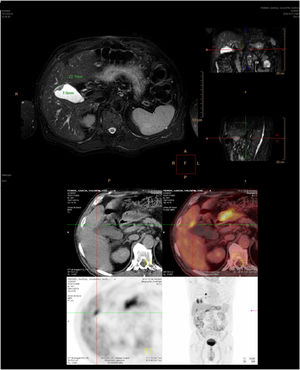 MRI and PET/CT prior to surgery.