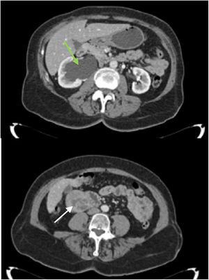 Right hydronephrosis (arrow A) cause by a heterogenous retroperitoneal mass (arrow B) adjacent to the 2nd portion of the duodenum.