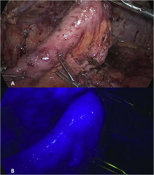Abdominal phase: A) Creation of the jejunal tube after dissection of the mesentery; B) Optimal perfusion of the jejunum is confirmed with indocyanine green fluorescence imaging prior to completing the abdominal phase.