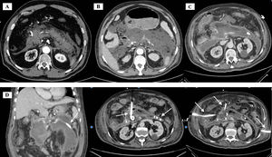 (A) abdominal CT scan at admission; (B) abdominal CT after 15 days of hospitalization; (C) abdominal CT after 29 days of hospitalization; (D) 3 percutaneous drain tubes placed under abdominal CT guidance successively for the drainage of the collection (marked with arrows).