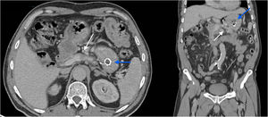Follow-up CT scan in the outpatient clinic 6 months after discharge, before withdrawal of the gastric stent (white arrow: atrophic pancreas; blue arrow: gastric stent).