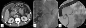 A) Abdominal CT with intravenous contrast showing periduodenal collection and intra-abdominal free fluid. The arrow indicates the neck of the pancreas, where the injury most likely occurred. B) Fistulography with filling of the collection and the distal Wirsung duct (dorsal pancreas). C) ERCP showing opacification of the pancreatic duct corresponding to the ventral pancreas, with no communication with the dorsal pancreas; no contrast extravasation.