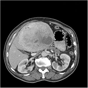 Sagittal CT scan, where the lesion is observed in close contact with the gastric wall.