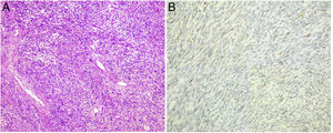 (A) Mesenchymal proliferation in bundles and fascicles with the presence of hyalinized collagen and branched vascular structures (haematoxylin eosin, 100×); (B) The neoplastic cellularity was intensely positive for CD34.