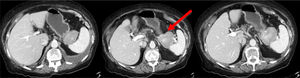 Abdominal CT scan, axial view: retroperitoneal mass located in the body/tail of the pancreas (red arrow).