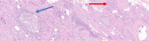 Hematoxylin-eosin stain ×40 and ×100 of the non-necrotizing granulomatous process: histiocytes and lymphocytes (blue arrow) in the pancreatic tissue, acini (red arrow), negative acid-fact bacilli.