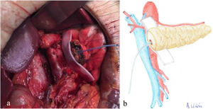 a) Intraoperative image of the placement of the biological mesh on the posterior side of the body of the pancreas; b) Diagram representing Fig. 1a.