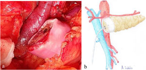 a) Intraoperative image of the final position of the biological mesh around the pancreatic remnant; b) Diagram representing Fig. 2a.