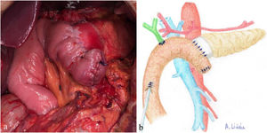 a) Intraoperative image after completing REDMA; b) Diagram representing Fig. 3a.