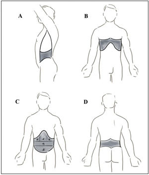 Abdominal regions analysed. A) Flanks; B) Thoracoabdominal; C) Anterior abdomen (1. Epigastrium; 2. Right hypochondrium; 3. Left hypochondrium; 4. Mesogastrium; 5. Hypogastrium); D) Lumbar.