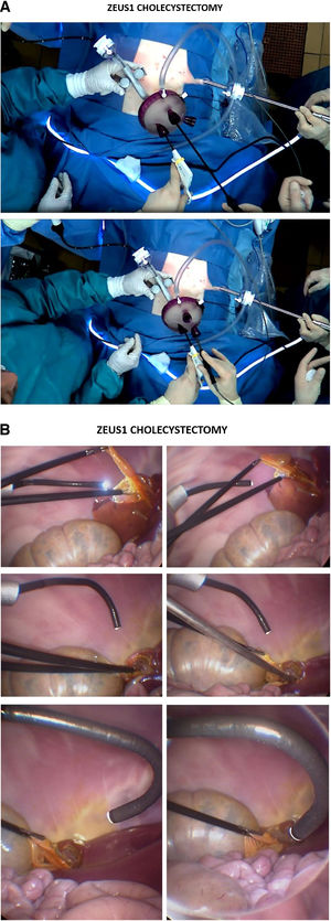 (A) Surgical field during ZEUS1 cholecystectomy. (B) ZEUS1 cholecystectomy: intracavitary view.