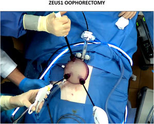Surgical field during ZEUS1 oophorectomy.