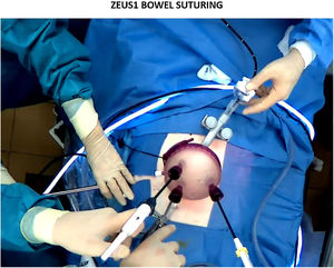 Surgical field during ZEUS1 bowel suturing.
