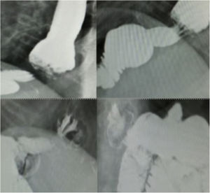 Barium swallow showing hiatal hernia.