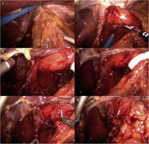 (A) Adhesions being released; (B) and (C) Exposure of the esophagus; (D) Closure of the crura; (E) and (F) Fixation of the lesser curvature to the preaortic fascia.