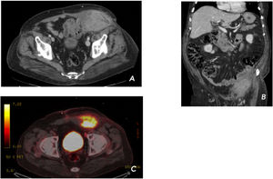 CT scan images (A, B) and PET/CT images (C), as described above.