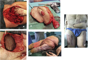 Images of the resection and reconstruction (A-D); result one month after surgery (E).