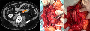 Left: CT scan showing the retroperitoneal lesion suspected of neoplastic recurrence. Right: intraoperative images showing the aorta, inferior vena cava, iliac arteries, left ureter and the aortoiliac bypass with Dacron® stent.