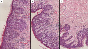 Histological findings in extramammary perianal primary Paget