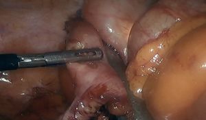 Laparoscopic endoscope-assisted wedge resection (EAWR) in the cecum.