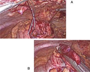 Laparoscopic endoscope-assisted transluminal resection (EATR): (A) Colotomy and exteriorization of the lesion after laparoscopic traction sutures; (B) mechanical resection of the tumor.