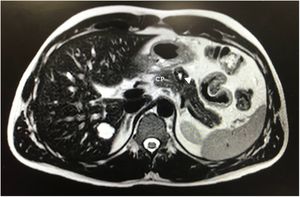 Magnetic resonance showing a 20-mm lesion, well defined and hyperintense in T2, in the body of the pancreas (white arrow) and its relationship with the pancreatic duct.