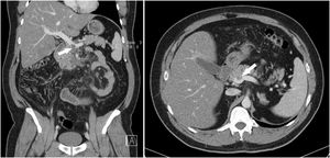 Coronal and axial computed tomography images showing the thrombus in the superior mesenteric vein in the confluence of the mesenteric-portal axis (arrow).