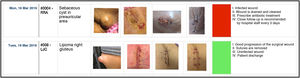 Follow-up of surgical wound healing using the original Apple® Numbers® application. The upper images (code RED) show the evolution of an infected surgical wound, while the lower images (code GREEN) show a case that progressed favorably.