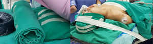 Placement of the patient: (a) Three supporting points to achieve slight hyperextension; (b) Immobilization of the head.