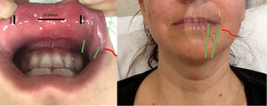 Suggested position of the trocars with relation to the mental nerve (green) and the marginal branch of the facial nerve (red).