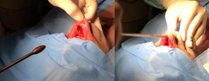 Dilatation of the subplatysmal space with Anuwong blunt dissection.